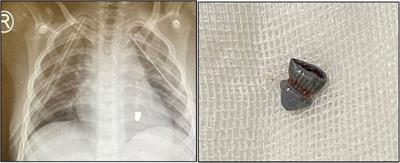 Missile embolism from pulmonary vein to left ventricle: report of a case